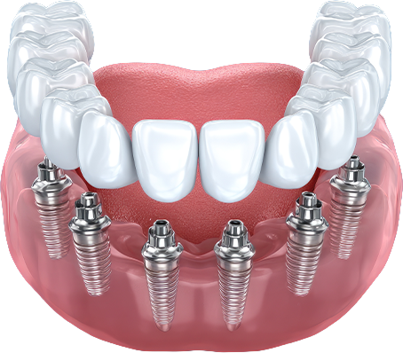 Patient completing a dental implant pricing survey