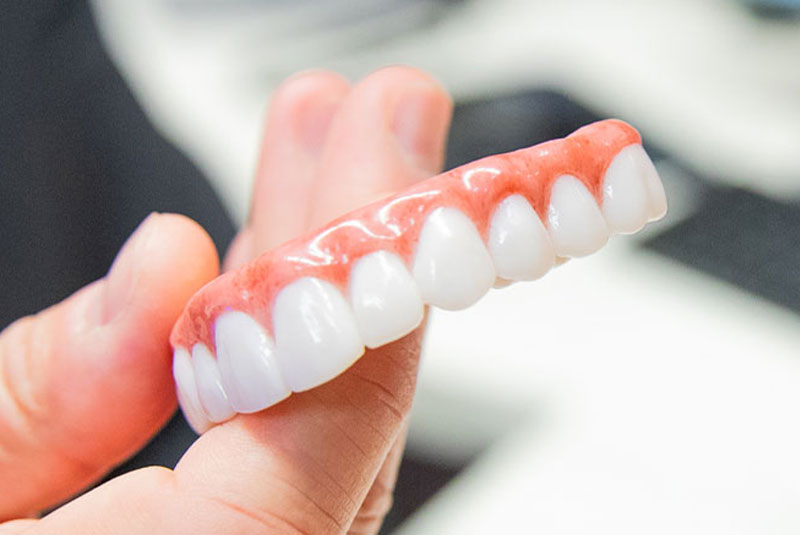 Full-arch fixed implant bridge