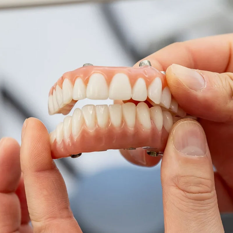 Full-arch dental implants