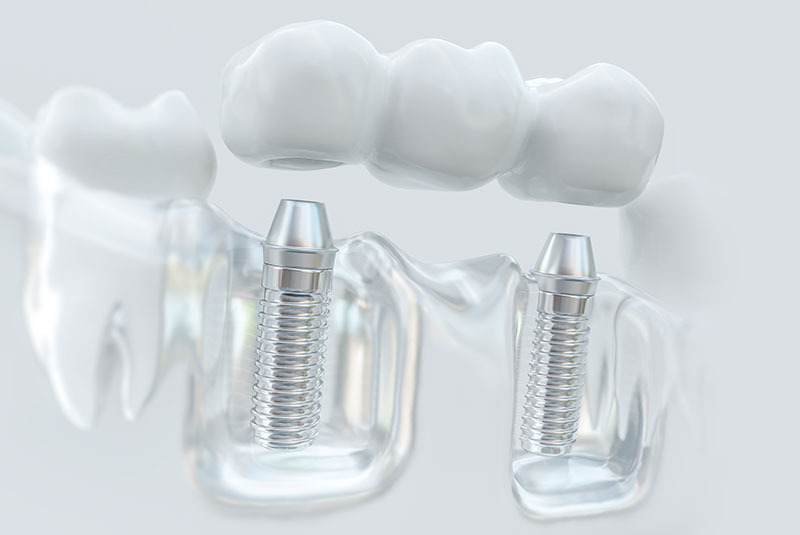 Implant-supported dental bridge