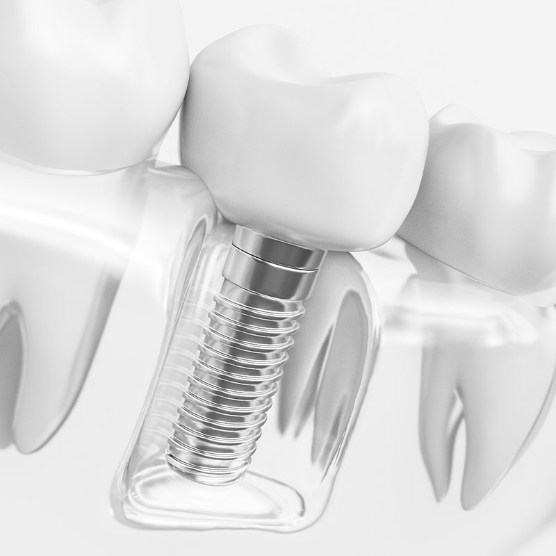 Single dental implant treatment