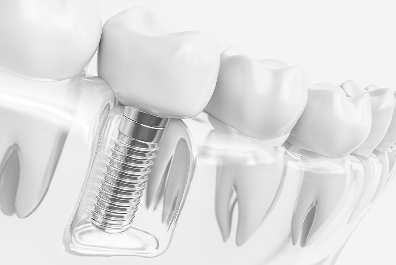 Single dental implant treatment