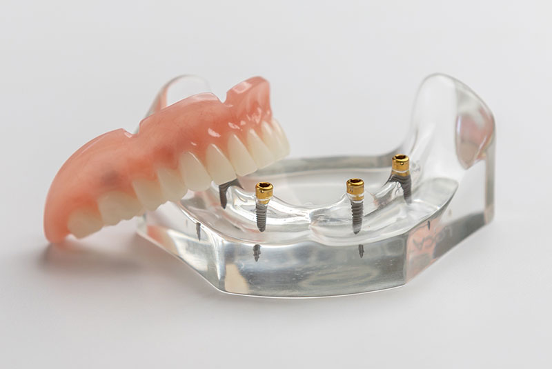 Implant-supported dentures